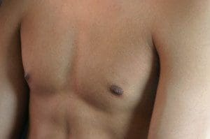treat-gynecomastia