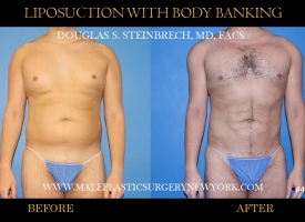 Bodybanking Lipo #1 copy