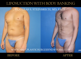 Bodybanking Lipo #2