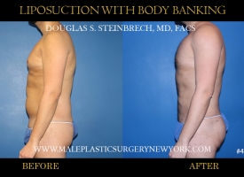 Bodybanking Lipo #3