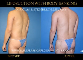 Bodybanking Lipo #4 copy