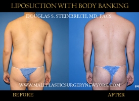 Bodybanking Lipo #5 copy