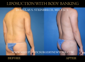 Bodybanking Lipo #6 copy