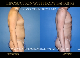 Bodybanking Lipo #7 copy