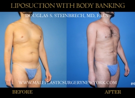 Bodybanking Lipo #8 copy