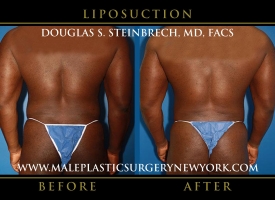 New-York-Liposuction-Back-Patient-8002