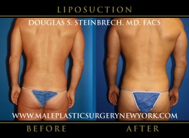 New-York-Liposuction-Back-Patient-8003