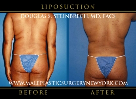 New-York-Liposuction-Back-Patient-8004