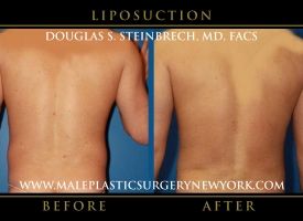New-York-Liposuction-Back-Patient-8007