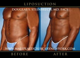 New-York-Liposuction-Front-Left-Oblique-Patient-8002