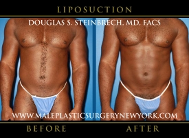 New-York-Liposuction-Front-Patient-8002