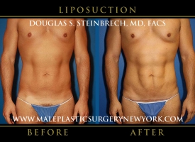 New-York-Liposuction-Front-Patient-8003