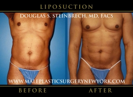 New-York-Liposuction-Front-Patient-8004