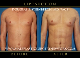 New-York-Liposuction-Front-Patient-8007