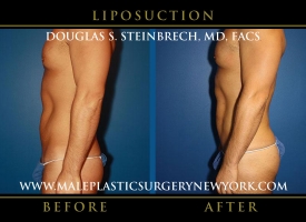 New-York-Liposuction-Left-Side-Patient-8003