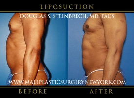 New-York-Liposuction-Left-Side-Patient-8004