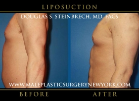 New-York-Liposuction-Left-Side-Patient-8007