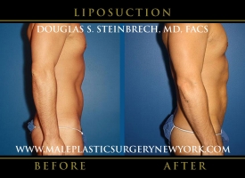 New-York-Liposuction-Right-Side-Patient-8003