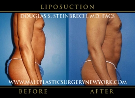 New-York-Liposuction-Right-Side-Patient-8004