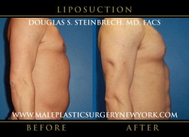 New-York-Liposuction-Right-Side-Patient-8007