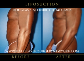 New-York-Liposuction-Side-Left-Patient-8002