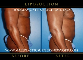 New-York-Liposuction-Side-Right-Patient-8002