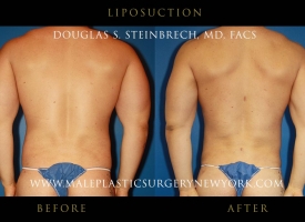 liposuction-NYC-before-after-photo-back