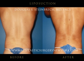liposuction-NYC-before-after-photo-back2