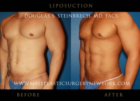 liposuction-NYC-before-after-photo-front-left