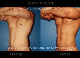liposuction-NYC-before-after-photo-front-left2