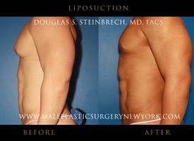 liposuction-NYC-before-after-photo-left