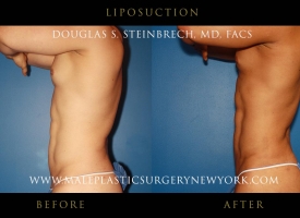 liposuction-NYC-before-after-photo-left2