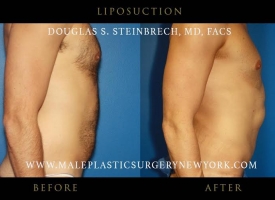 liposuction-before-after-photo-NYC-DSS-0029