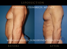 liposuction-mps-ny-4