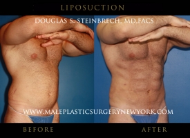 liposuction-mps-ny-6