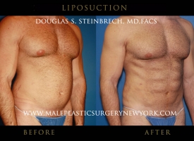 liposuction-mps-ny-7
