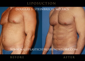 liposuction-mps-ny-8