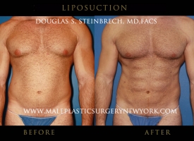 liposuction-mps-ny-9