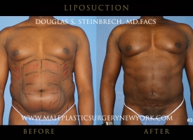 liposuctionny