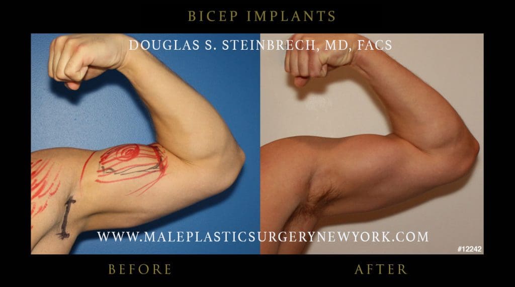 bicep-implants-before-after-nyc-2-12242