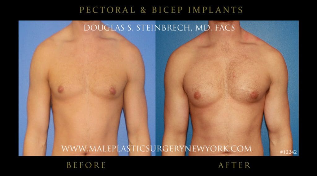 pectoral-bicep-implants-before-after-nyc-001