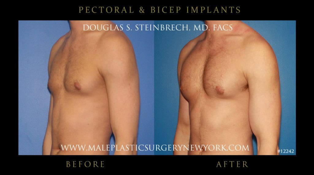 pectoral-bicep-implants-before-after-photos-nyc-001