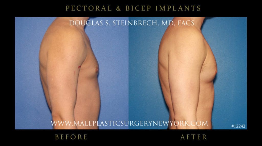 pectoral-bicep-implants-before-after-photos-nyc-002