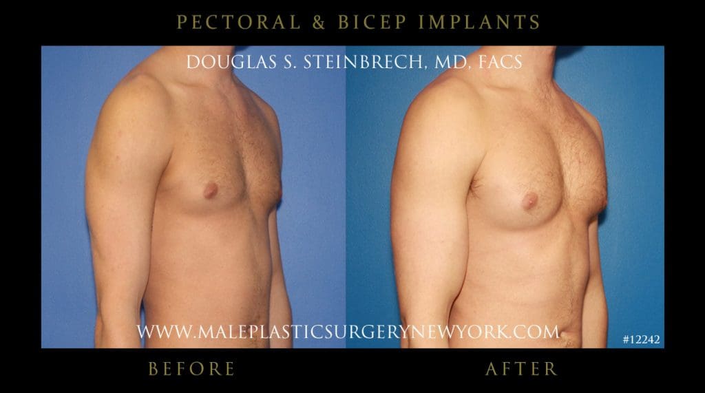pectoral-bicep-implants-photos-nyc-003