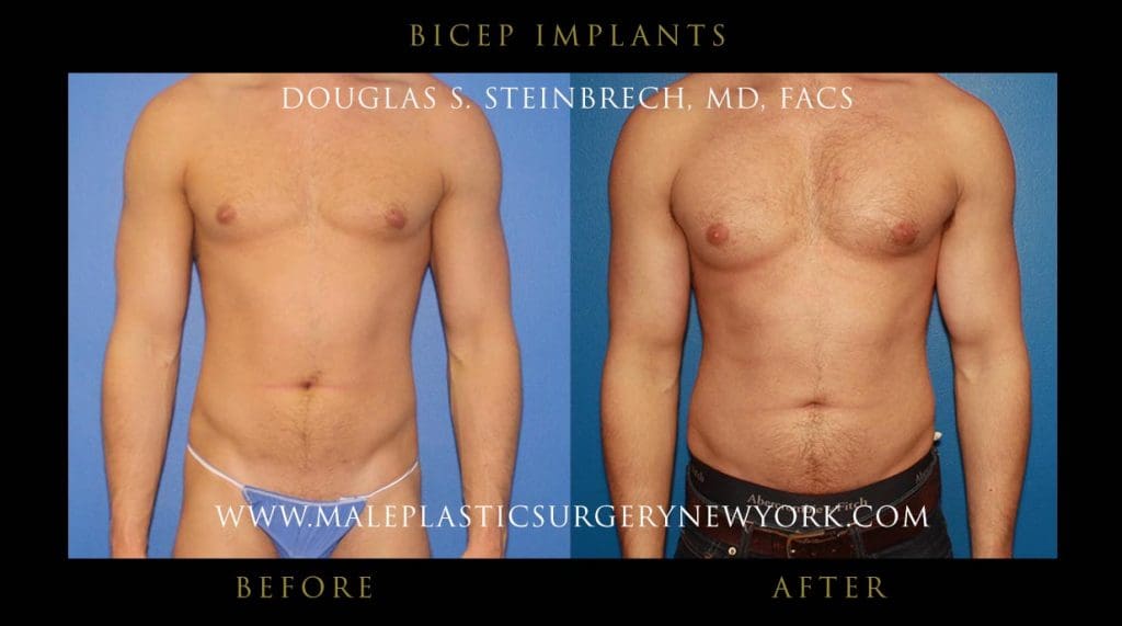 bicep-implants-NYC-before-after-photo–front
