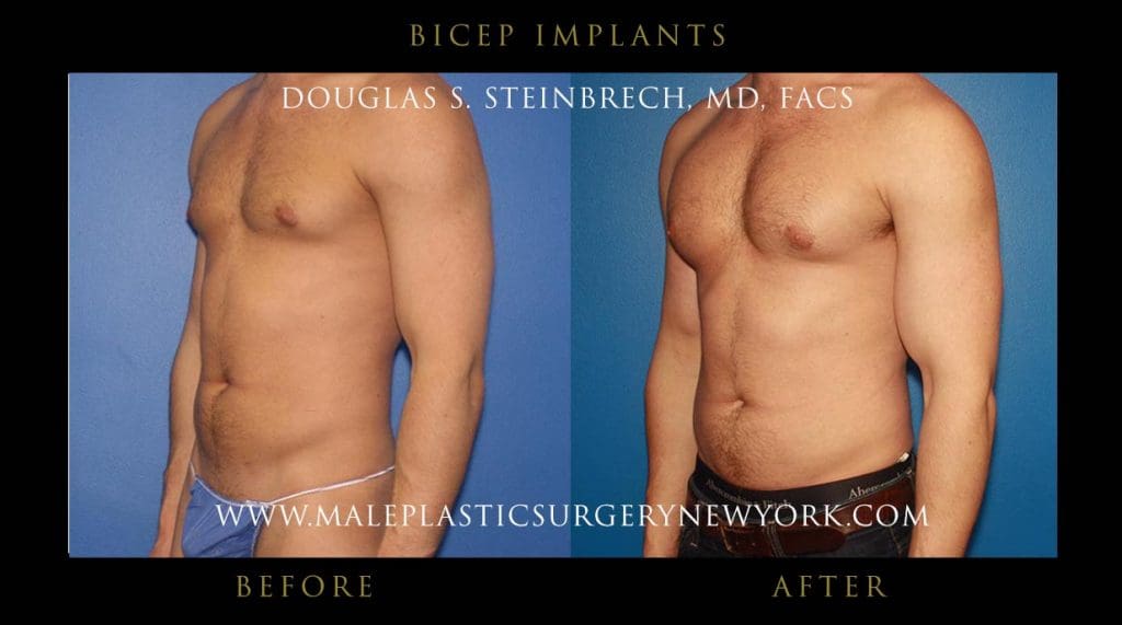 bicep-implants-NYC-before-after-photo-front-left