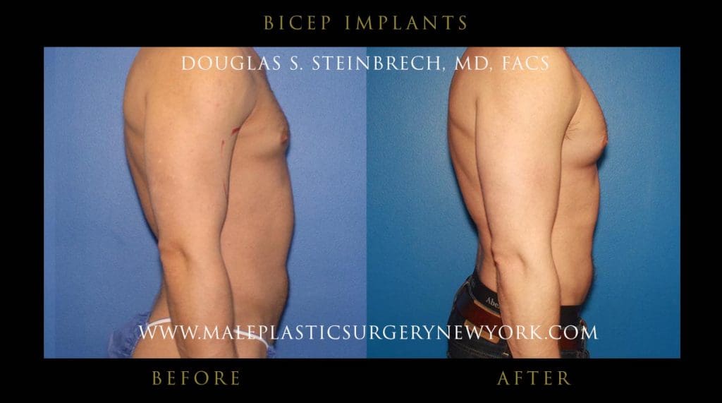 bicep-implants-NYC-before-after-photo-right