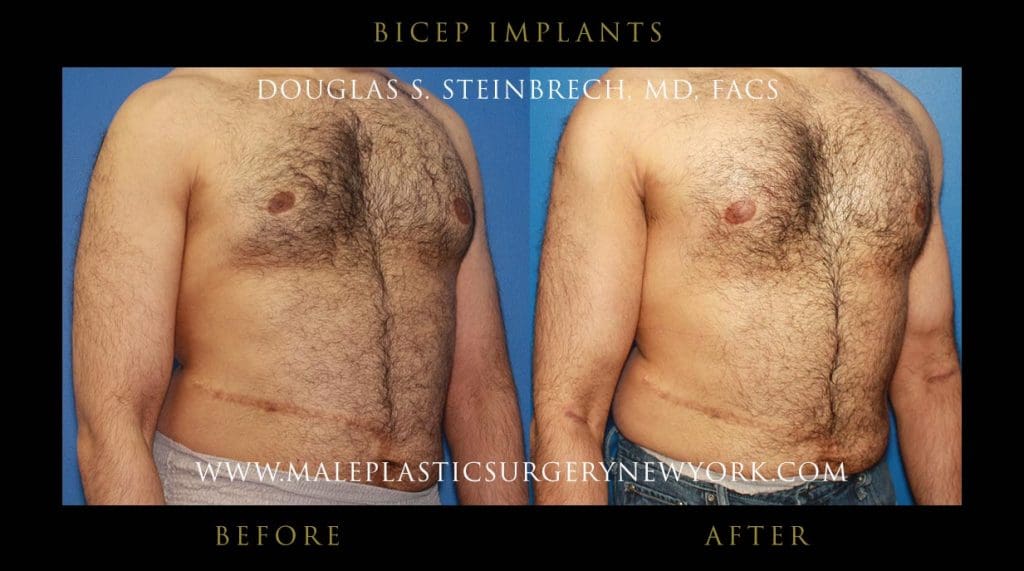 bicep-implants-front-right