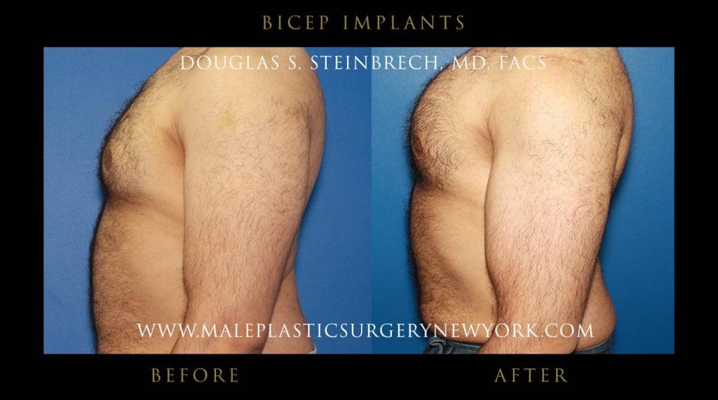 bicep-implants-left
