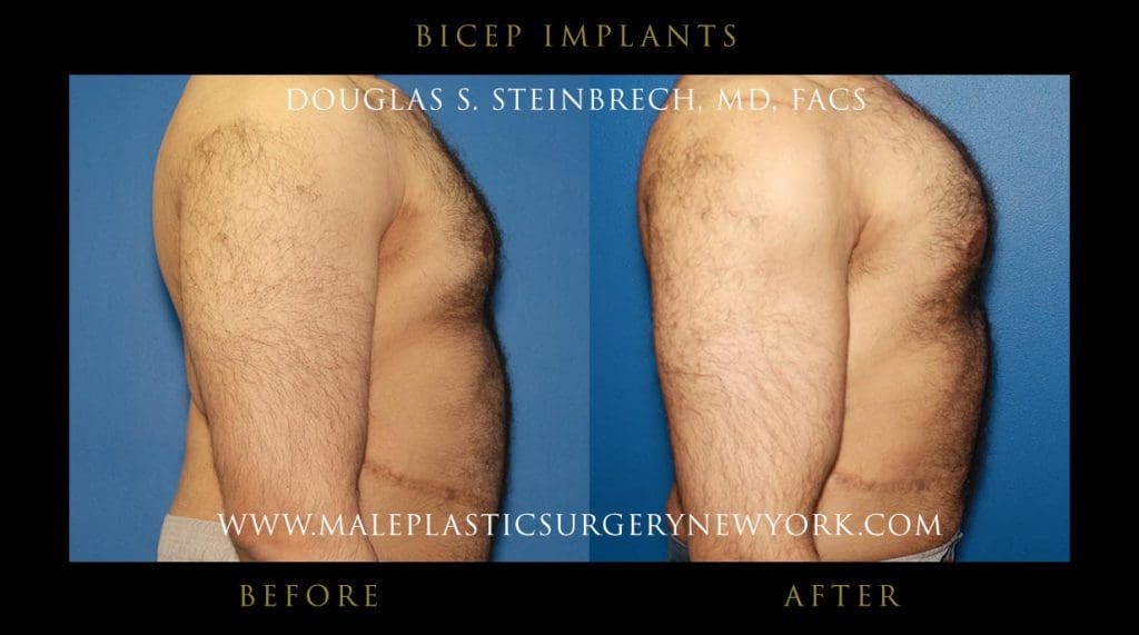 bicep-implants-right